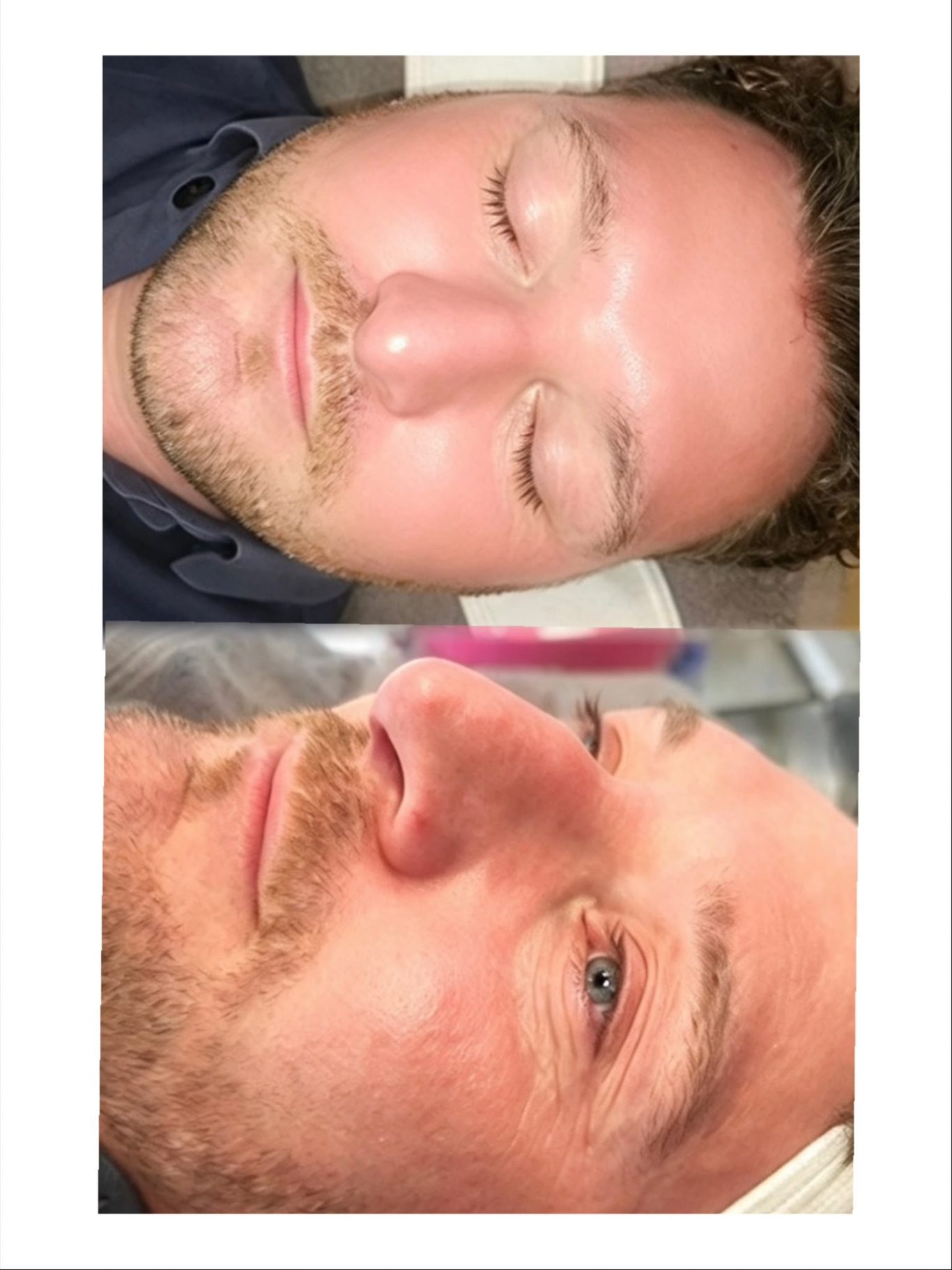 Before and After microneedling-treatment-oldham.jpg