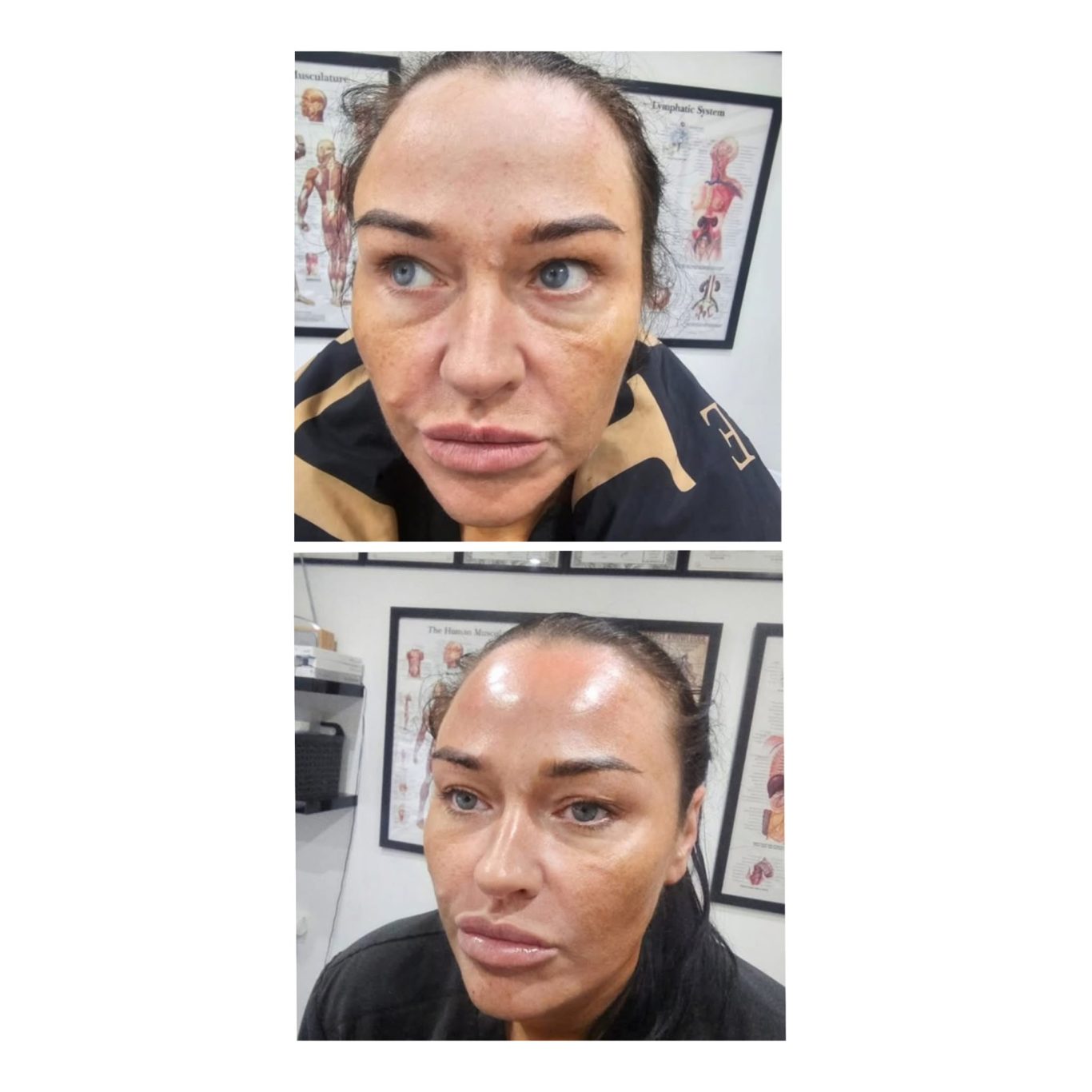 prp-facial-before-after-oldham.jpg PRP facial before and after results in Oldham