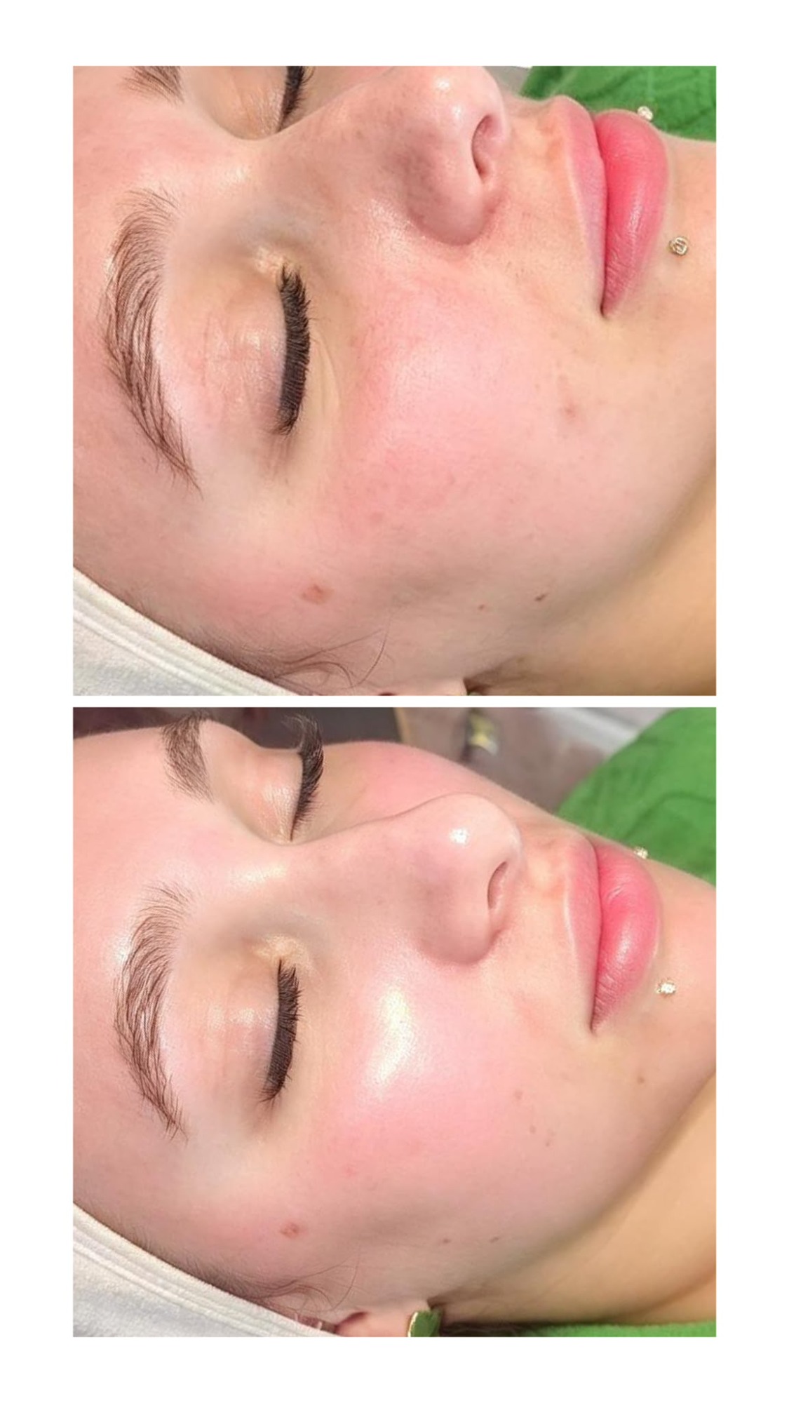 Before and After microneedling-before-after-skin-texture.jpg