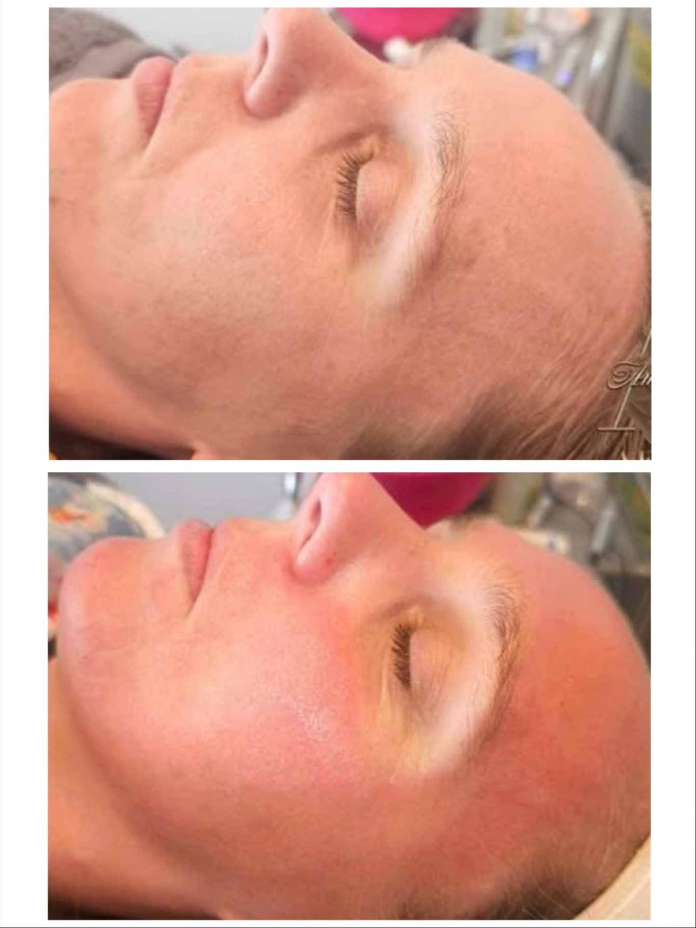 Before and After microneedling-acne-scars-oldham.jpg
