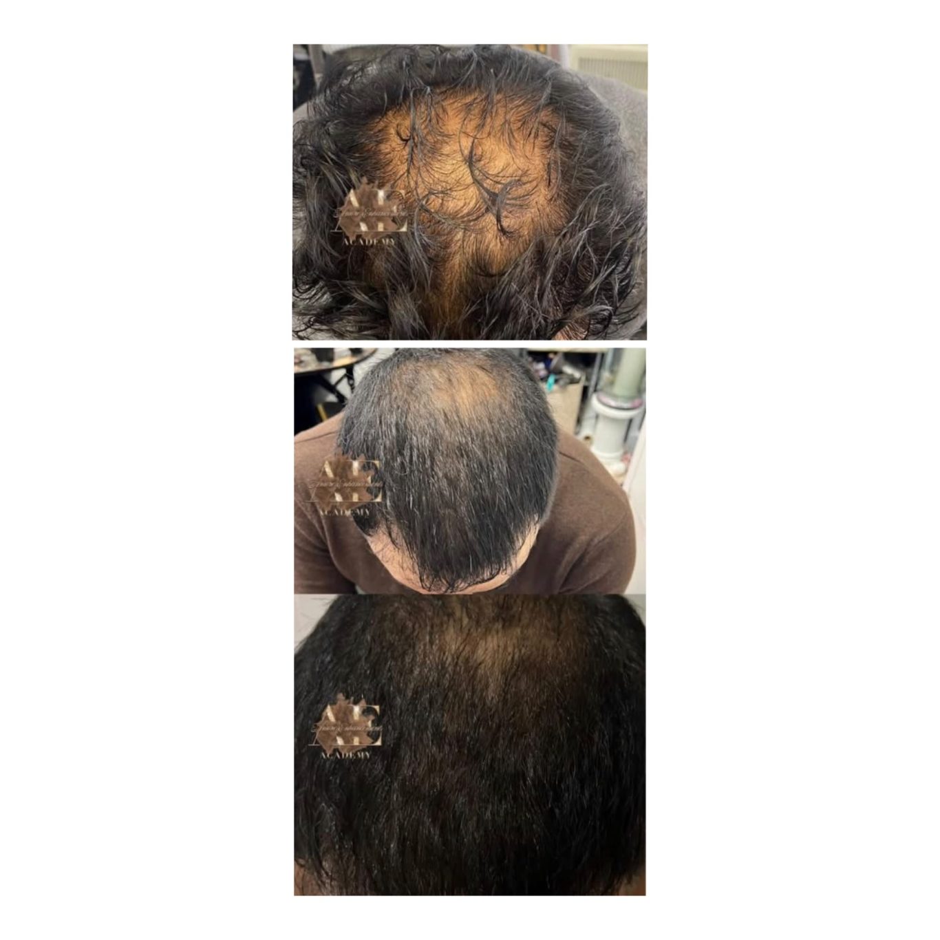 prp-hair-thinning-before-after-manchester.jpg PRP treatment for thinning hair before and after in Manchester