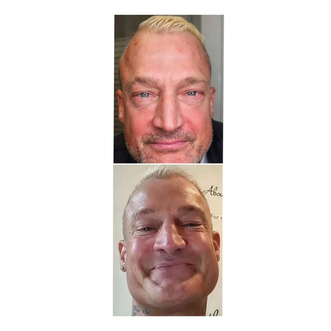 prp-injections-before-after-oldham.jpg PRP facial results before and after treatment in Manchester