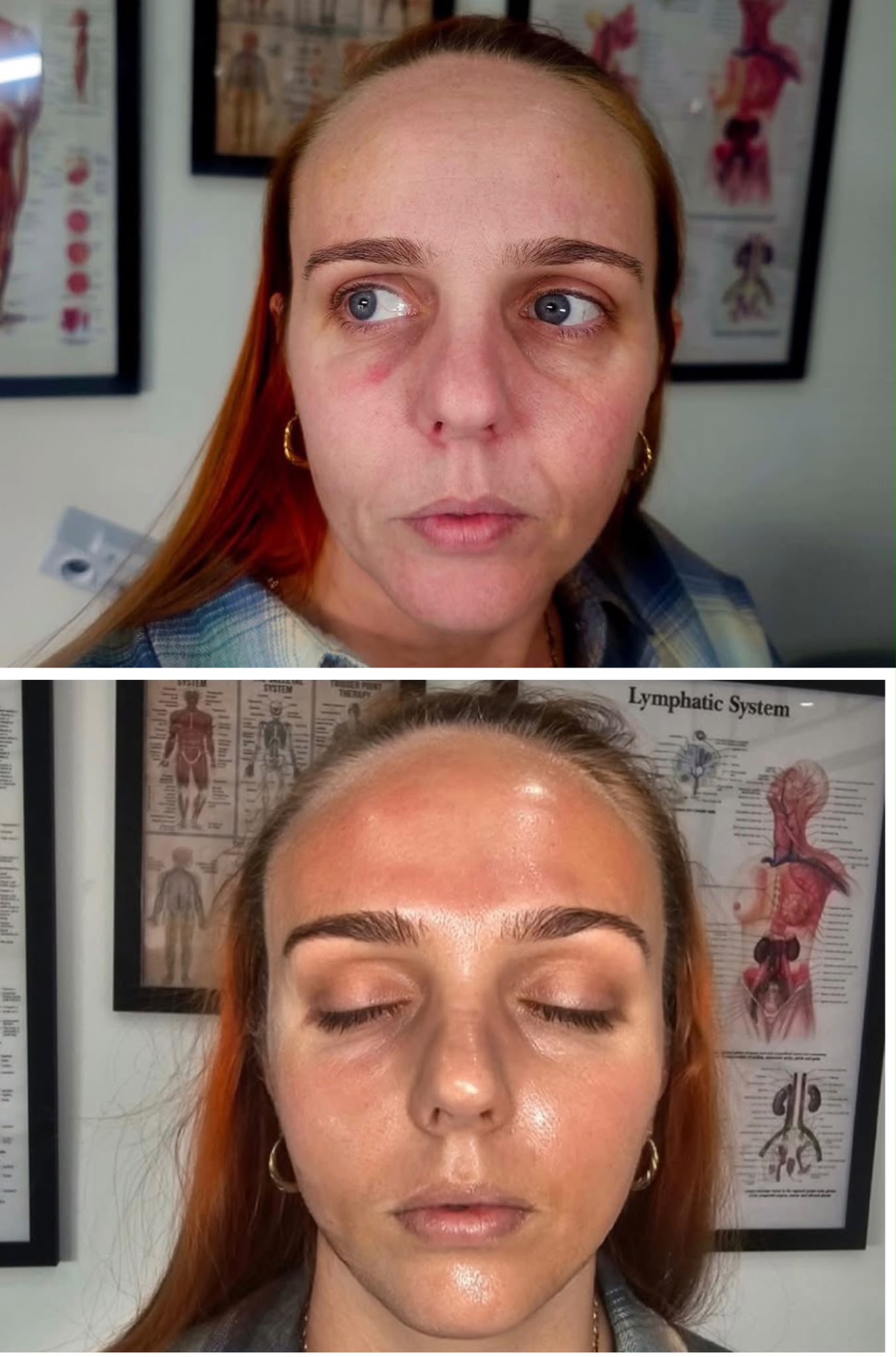 prp-skin-rejuvenation-before-after-oldham.jpg PRP skin rejuvenation before and after treatment in Oldham