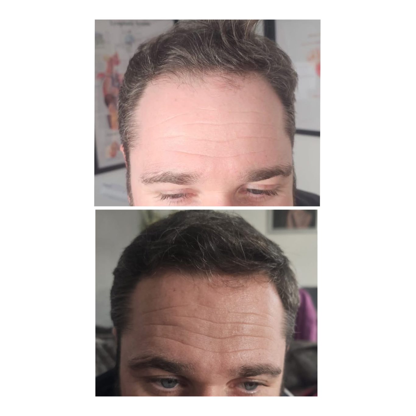 prp-hair-restoration-before-after-oldham.jpg PRP hair restoration before and after results in Oldham